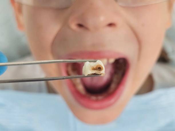 Best Broken Tooth Emergency  in Val Verde, CA